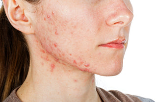 Acne & Acne-Prone Skin