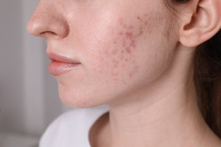 Dark Spots & Hyperpigmentation