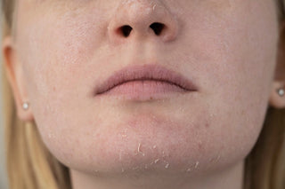Dry & Dehydrated Skin