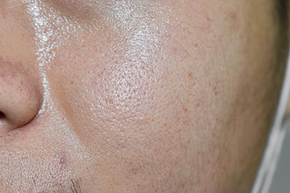 Oily Skin & Large Pores
