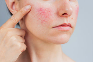 Sensitive Skin & Rosacea
